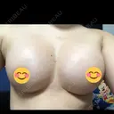 豊胸（脂肪注入） 水の森美容クリニック 名古屋院 DAY 15 サムネイル用