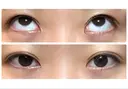 二重切開 / 上まぶたたるみ取り / 上まぶたの脂肪取り / 目元修正 リビジョンクリニック（旧：池本形成外科・美容外科） DAY 62 サムネイル用