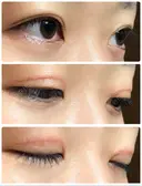 二重切開 / 上まぶたたるみ取り / 上まぶたの脂肪取り / 目元修正 リビジョンクリニック（旧：池本形成外科・美容外科） DAY 62 サムネイル用