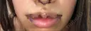 人中短縮 / 口角挙上 / その他（口元） 清潭女神美容外科 DAY 2 サムネイル用