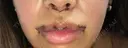 人中短縮 / 口角挙上 / その他（口元） 清潭女神美容外科 DAY 3 サムネイル用