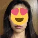 脂肪溶解注射（顔） / 美容点滴・美容注射（美肌） / ボトックス（肩） / ハイフ（顔） リエンジャン整形外科 江南店 DAY 3 サムネイル用