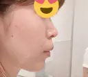 ボトックス（あご） / ヒアルロン酸注入（あご） / その他（輪郭） 品川美容外科 仙台院 DAY 3 サムネイル用