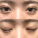 二重埋没 湘南美容クリニック 新宿本院 DAY 17 サムネイル用