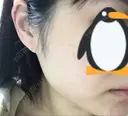 ボトックス（エラ・小顔） 品川スキンクリニック岡山院 DAY 16 サムネイル用