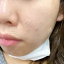 ほくろ・いぼ切除（肌） 赤坂メディカルMクリニック DAY 0 サムネイル用