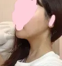 糸リフト / 脂肪吸引（顔） / その他（輪郭） / 切開リフト 清潭清楚整形外科 DAY 21 サムネイル用