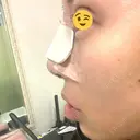 隆鼻術 / 鼻尖形成（切開） / 鼻中隔延長（切開） / 骨切幅寄せ / プロテーゼ除去 / 鼻修正 FROM B整形外科 (旧バウム整形外科) DAY 0 サムネイル用