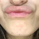 ボトックス（あご） TCB東京中央美容外科 京都駅前院 DAY 0 サムネイル用