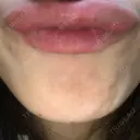 ボトックス（あご） TCB東京中央美容外科 京都駅前院 DAY 1 サムネイル用