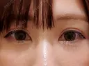 クマ治療 閉院｜プルージュ美容クリニック 赤羽院 AFTER サムネイル用