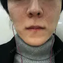 エレクトロポレーション 湘南美容クリニック 秋葉原院 DAY 4 サムネイル用