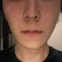 エレクトロポレーション 湘南美容クリニック 秋葉原院 DAY 5 サムネイル用