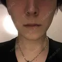 エレクトロポレーション 湘南美容クリニック 秋葉原院 DAY 6 サムネイル用