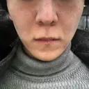 エレクトロポレーション 湘南美容クリニック 秋葉原院 DAY 8 サムネイル用