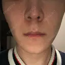 エレクトロポレーション 湘南美容クリニック 秋葉原院 DAY 7 サムネイル用