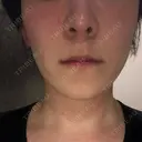 エレクトロポレーション 湘南美容クリニック 秋葉原院 DAY 9 サムネイル用