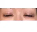 自然癒着法 ララ整形外科 DAY 10 サムネイル用