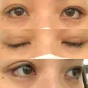 眼瞼下垂（切開） / 目尻切開 / タレ目形成・グラマラスライン（切開） プロミス整形外科 DAY 7 サムネイル用