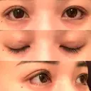 眼瞼下垂（切開） / 目尻切開 / タレ目形成・グラマラスライン（切開） プロミス整形外科 DAY 8 サムネイル用