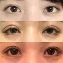 眼瞼下垂（切開） / 目尻切開 / タレ目形成・グラマラスライン（切開） プロミス整形外科 DAY 8 サムネイル用