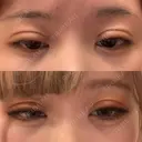 二重切開 大阪梅田中央クリニック美容外科 DAY 30 サムネイル用