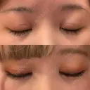 二重切開 大阪梅田中央クリニック美容外科 DAY 30 サムネイル用