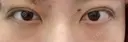 二重埋没 / 上まぶたの脂肪取り 湘南美容クリニック 柏院 DAY 0 サムネイル用