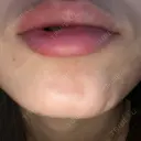 ボトックス（あご） TCB東京中央美容外科 京都駅前院 DAY 4 サムネイル用