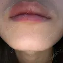 ボトックス（あご） TCB東京中央美容外科 京都駅前院 DAY 4 サムネイル用