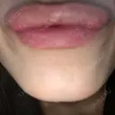 ボトックス（あご） TCB東京中央美容外科 京都駅前院 DAY 4 サムネイル用