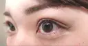 二重埋没 / 上まぶたの脂肪取り TCB東京中央美容外科 江坂院 DAY 29 サムネイル用