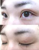二重埋没 / 上まぶたの脂肪取り TCB東京中央美容外科 江坂院 DAY 29 サムネイル用