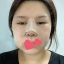 鼻中隔延長（切開） / 軟骨移植 / 眉間プロテーゼ FROM B整形外科 (旧バウム整形外科) DAY 2 サムネイル用