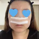 鼻中隔延長（切開） / 軟骨移植 / 眉間プロテーゼ FROM B整形外科 (旧バウム整形外科) DAY 2 サムネイル用