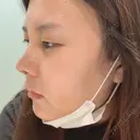 鼻中隔延長（切開） / 軟骨移植 / 眉間プロテーゼ FROM B整形外科 (旧バウム整形外科) DAY 5 サムネイル用