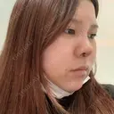 鼻中隔延長（切開） / 軟骨移植 / 眉間プロテーゼ FROM B整形外科 (旧バウム整形外科) DAY 5 サムネイル用