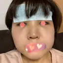 バッカルファット除去 湘南美容クリニック 新潟院 DAY 2 サムネイル用