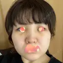 バッカルファット除去 湘南美容クリニック 新潟院 DAY 4 サムネイル用