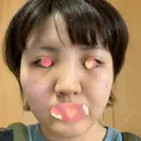 バッカルファット除去 湘南美容クリニック 新潟院 DAY 7 サムネイル用