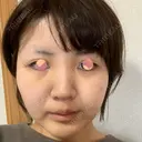 バッカルファット除去 湘南美容クリニック 新潟院 DAY 8 サムネイル用