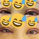 二重切開 / 目頭切開 / 鼻尖形成（切開） / 鼻中隔延長（切開） / 小鼻縮小（切開） / タレ目形成・グラマラスライン（切開） / 鼻尖縮小 / 鼻翼基部形成（貴族手術） グローバルビューティークリニック 大阪院 DAY 4 サムネイル用