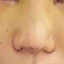 二重切開 / 目頭切開 / 鼻尖形成（切開） / 鼻中隔延長（切開） / 小鼻縮小（切開） / タレ目形成・グラマラスライン（切開） / 鼻尖縮小 / 鼻翼基部形成（貴族手術） グローバルビューティークリニック 大阪院 DAY 4 サムネイル用