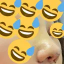 二重切開 / 目頭切開 / 鼻尖形成（切開） / 鼻中隔延長（切開） / 小鼻縮小（切開） / タレ目形成・グラマラスライン（切開） / 鼻尖縮小 / 鼻翼基部形成（貴族手術） グローバルビューティークリニック 大阪院 DAY 4 サムネイル用