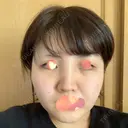 バッカルファット除去 湘南美容クリニック 新潟院 DAY 9 サムネイル用