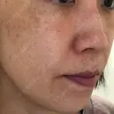 シミ取りレーザー 仁愛クリニック DAY 151 サムネイル用