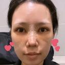目頭切開 / 鼻尖形成（切開） / 額を丸く / 目尻切開 / 上まぶたの脂肪取り / 軟骨移植 / 脂肪注入（輪郭） TN整形外科 DAY 5 サムネイル用