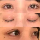 眼瞼下垂（切開） / 目尻切開 / タレ目形成・グラマラスライン（切開） プロミス整形外科 DAY 13 サムネイル用