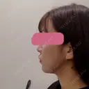 ボトックス（エラ・小顔） 湘南美容クリニック 秋葉原院 AFTER サムネイル用