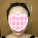 糸リフト / 骨削り（頬） / 脂肪吸引（顔） RG整形外科（旧リオン整形外科） DAY 29 サムネイル用